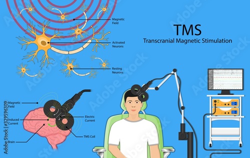 Transcranial magnetic stimulation TMS non invasive field obsessive compulsive disorder PTSD treat