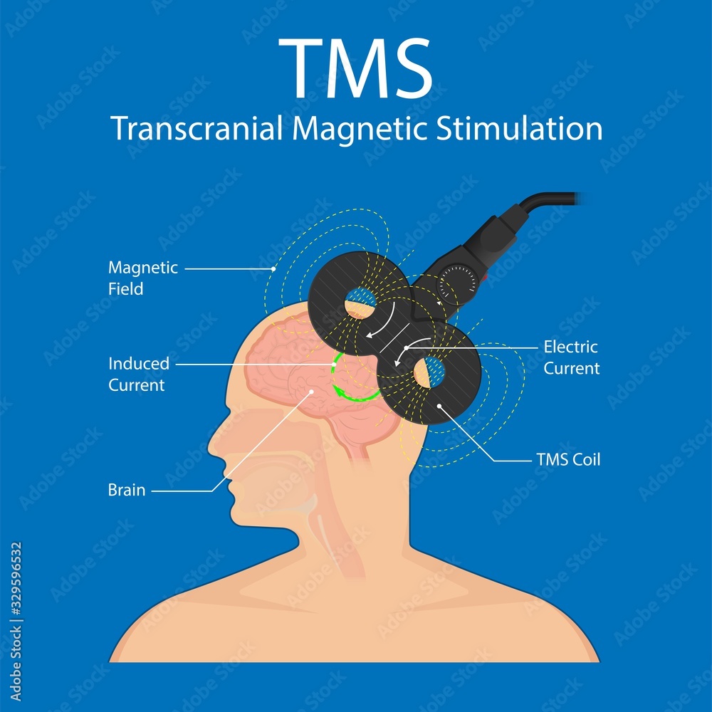 Transcranial Magnetic Stimulation Tms Non Invasive Field Obsessive