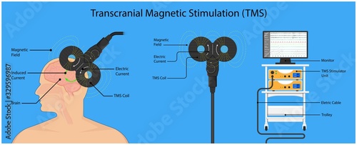 Transcranial magnetic stimulation TMS non invasive field obsessive compulsive disorder PTSD treat