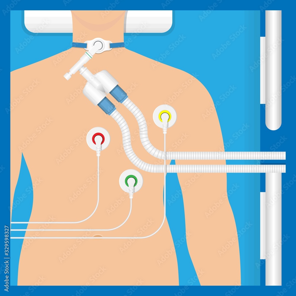 Vetor do Stock Ventilator Medical Machine Equipment for Tracheostomy
