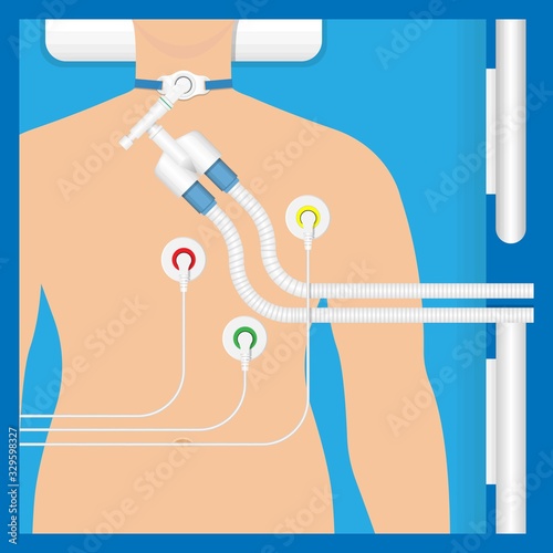 Ventilator Medical Machine Equipment for Tracheostomy Patient Breathing in Operating Room Surgery Hospital Clinical ICU Intensive Care Unit Bag Valve Mask
