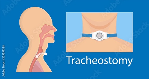 Tracheostomy surgical patient treatment procedure medical allergy neck trachea hole vocal cord paralysis percutaneous