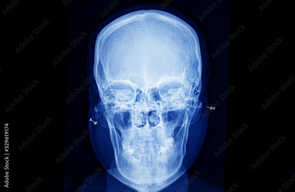 X-Ray of human skull bone 