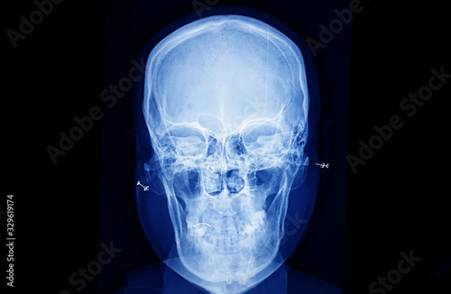 X-Ray of human skull bone 
