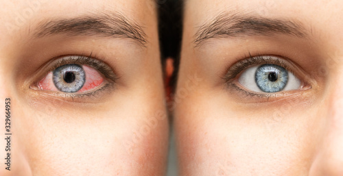 Tableau sur toile Comparing of eye before and after eyedrop treatment