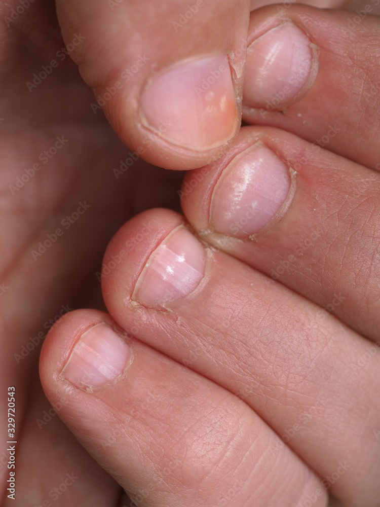 White spots on the nails of the male hand caused by a deficiency of