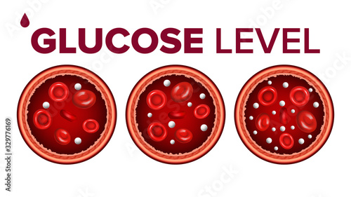 Glucose Sugar Level In Blood And Red Cells Vector. Hypoglycemia, Normal Glucose Level And Hyperglycemia, Aorta Or Vein Artery. Medical Education Diagram Template Realistic 3d Illustration