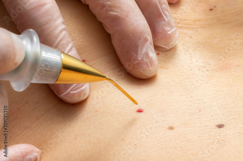 Bild auf Leinwand Macro close up of laser plasma pen removing cherry angioma on human skin