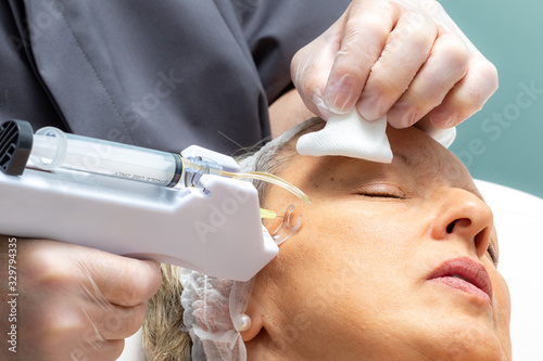Foto Middle aged woman having micro needling therapy on crow's feet.