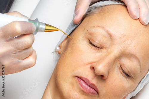 Photos Top view of laser plasma pen removing facial wart on middle aged woman