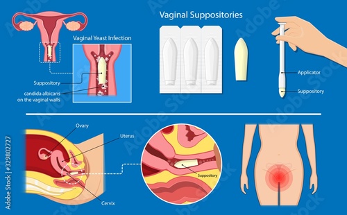 vaginal yeast infections treatment applicator symptoms natural remedies vulvovaginitis itchy hormone estrogen weakened immune system sex sexual contact vaginosis bacteria suppository