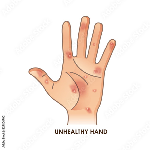 Unhealthy hand vector illustration. Acne, boils, psoriasis, ringworm