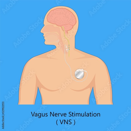 Vagus nerve stimulation VNS device depression electrical impulses treat epilepsy 