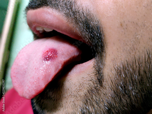 A closeup of a diseased tongue in which a red spot glosses. Burning and discomfort of the tongue