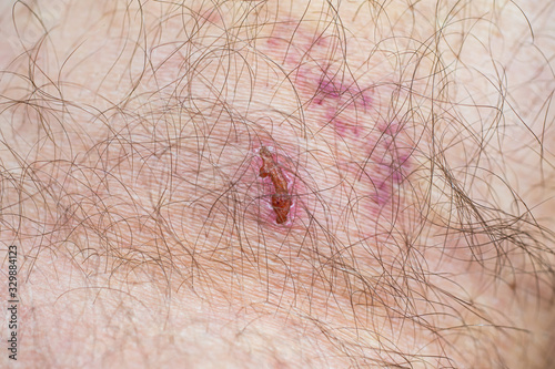 Caucasian male hairy leg wounded skin with bruise and scaring close up macro shot
