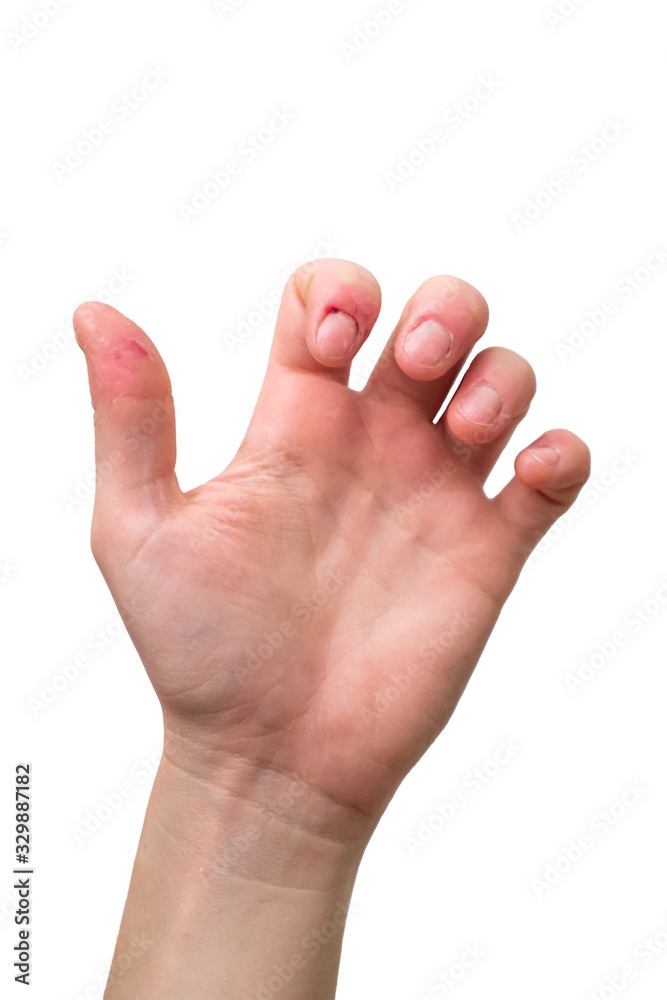White Caucasian female hand in a light grip position showing off bitten fingers from Dermatophagia disorder isolated against pure white background White Caucasian female hand in a light grip position showing off bitten fingers from Dermatophagia disorder isolated against pure white background