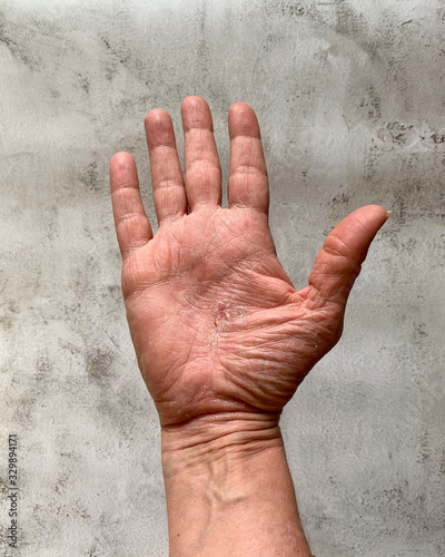 A palm, red, itchy, dry, eczema that hurts and needs treatment from the health care system. Inflammation and painful condition. Gray background. photo