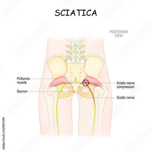 sciatica. piriformis syndrome photo