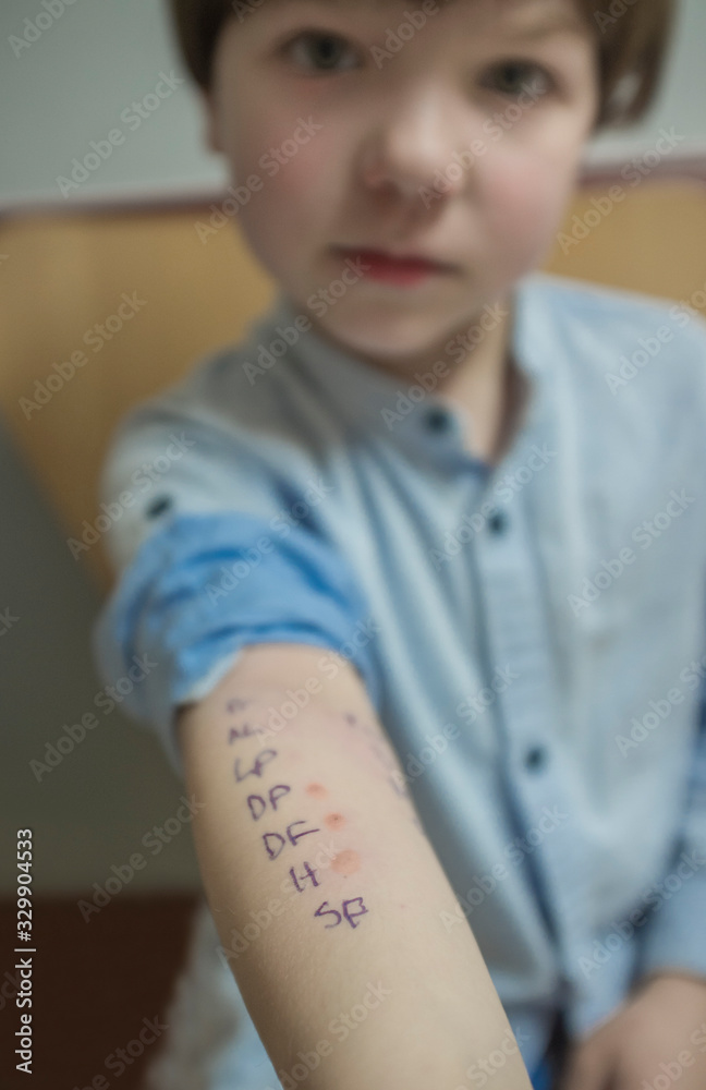 Little boy full of weals just after doing allergy skin prick test