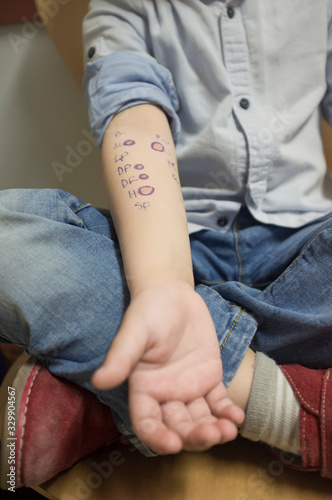 Little boy shows his arm after nurse encircled the allergy positive dots