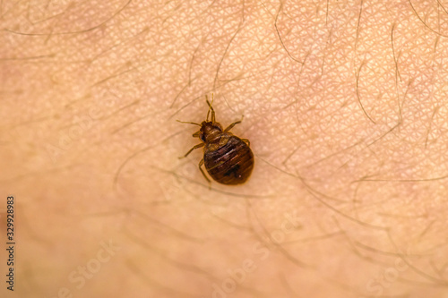Bed Bug On Skin 