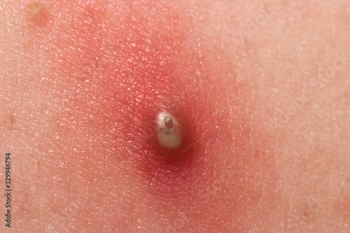 abscess, abscesses, accident, acupuncture, antibiotics, bacteria, blood, body, care, close, closeup, crater, dirty, doctor, freckles, hand, health, hospital, human, hurt, illness, incision, infected, 