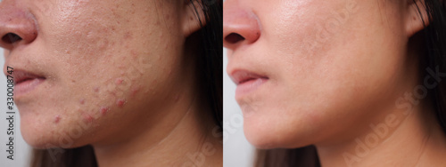 Image before and after spot red scar acne.pimples treatment on face asian woman.Problem skincare and beauty concept.