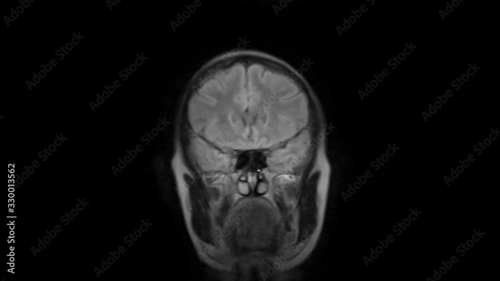 Purified MRI brain, head scans and tumor detection. Diagnostic medical tool