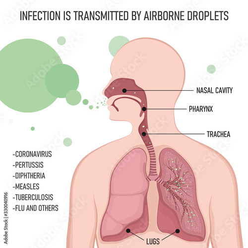 Infection is transmitted by airborne droplets. Human body with lungs affected by virus cells through the respiratory tract.