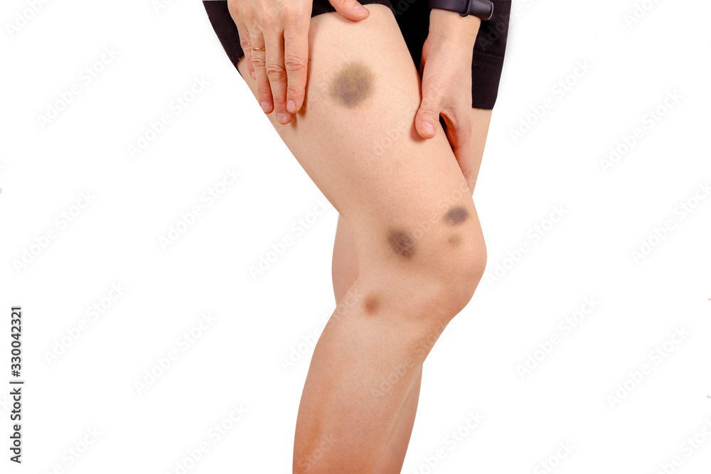 Naklejka premium Sports injury, painful scratches and open wounds on leg of runner girl