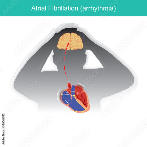Atrial Fibrillation. Patients condition in which the electrical signals in heart malfunctioning or causing a short circuit in heart rhythm.