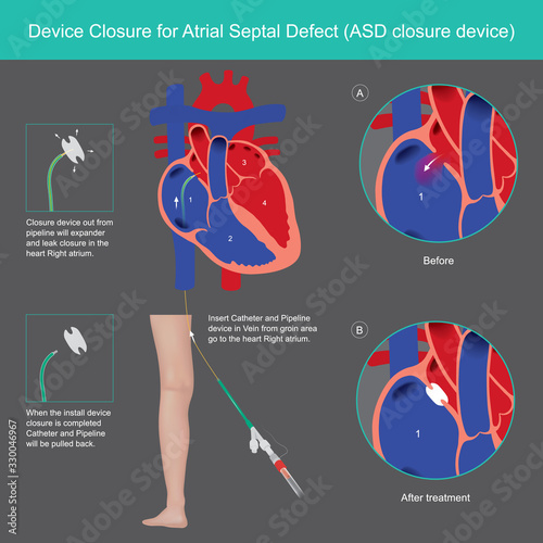 Devices Closure for Atrial Septal Defect. Explain treatment The Atrial Septal Defect (ASD) abnormality by use medical Devices Closure wall heart in Right atrium.