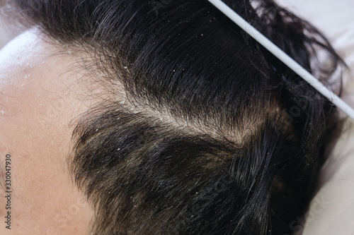 Close up of a hair dandruff , Black hair
 photo