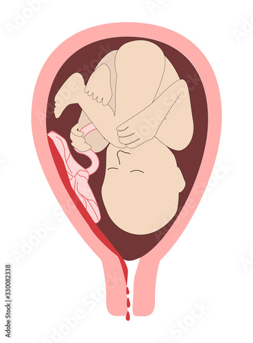 child in the womb. The detachment of the placenta, placental abruption. Vaginal bleeding. Dangerous complication of pregnancy,