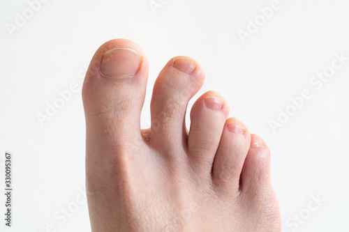 Right Caucasian male foot top view with bent crooked toe against bright white background close up photo