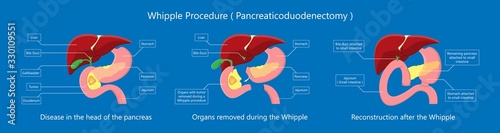 Whipple procedure pancreaticoduodenectomy Pancreatic cancer treatment total pancreatectomy Small bowel surgical  photo