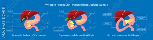 Whipple procedure pancreaticoduodenectomy Pancreatic cancer treatment total pancreatectomy Small bowel surgical 