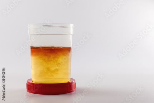 Plastic jars for medical tests with yellow urine on a blue background. Drug, alcohol, and disease tests.