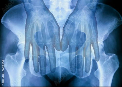 X-ray plate of the both human hands and pelvic bones. Shyness, modesty
