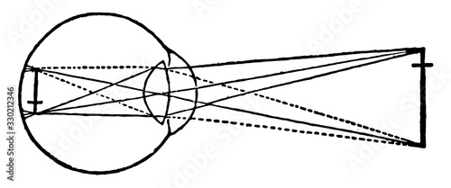 Nearsighted Vision, vintage illustration.
