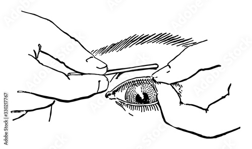 Everted eyelid, vintage illustration.