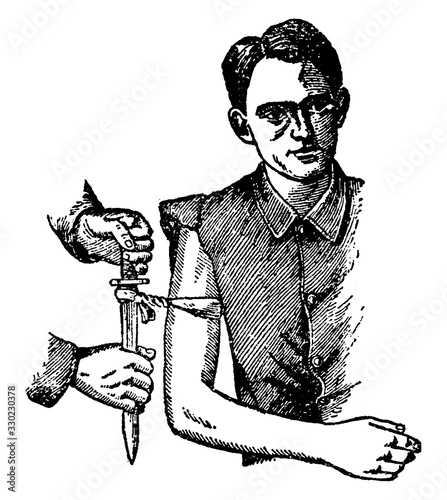 Improvised Tourniquet, vintage illustration