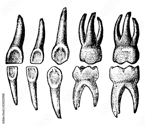 Temporary Teeth, vintage illustration.