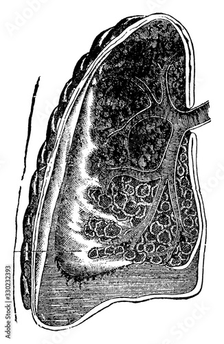 Lung with Pneumonia, vintage illustration
