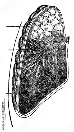 Lung with Pneumonia, vintage illustration