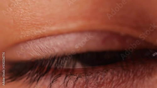 Close-up of brown eye blinking in Slow Motion. Woman is opening and closing her eye with Pterygium. photo