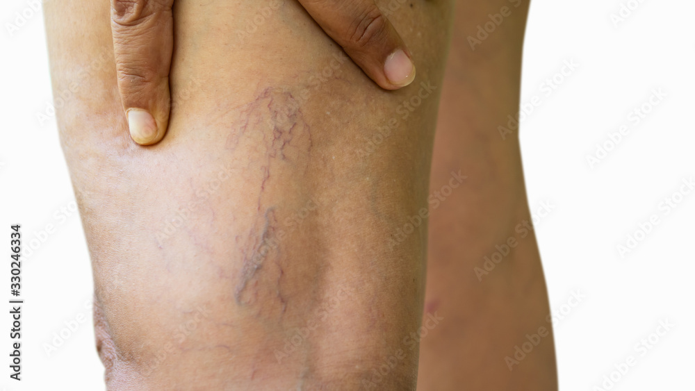 Naklejka premium Varicose veins on young women legs