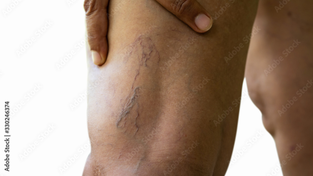 Naklejka premium Varicose veins on young women legs