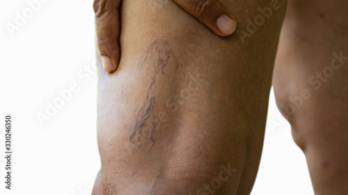 Varicose veins on young women legs