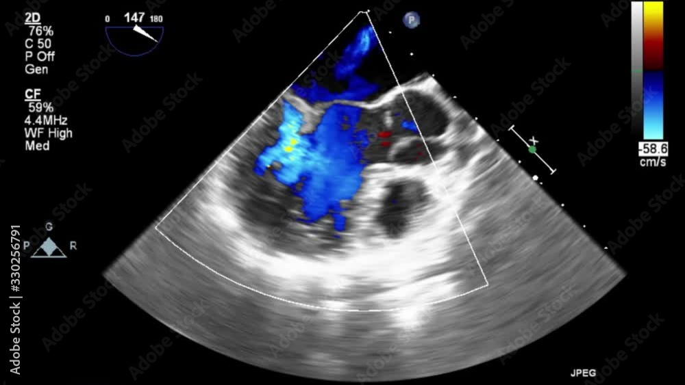 Transesophageal ultrasound video in Doppler mode.